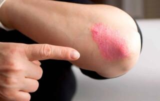 Psoriasis y los beneficios del sol para paliar sus síntomas