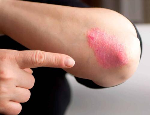 Psoriasis y los beneficios del sol para paliar sus síntomas