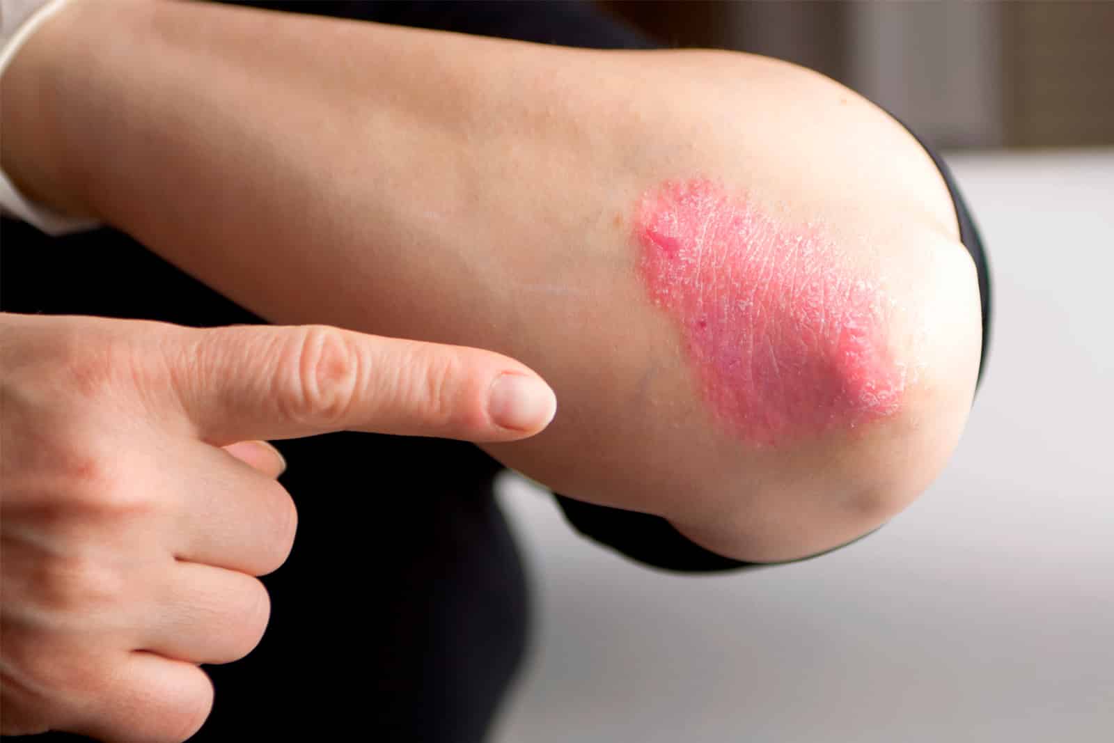 Psoriasis y los beneficios del sol para paliar sus síntomas